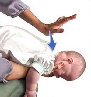 Если подавился малыш